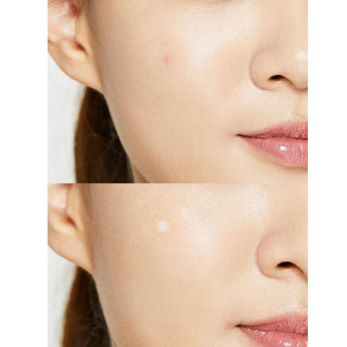 Acne Pimple Master Patch